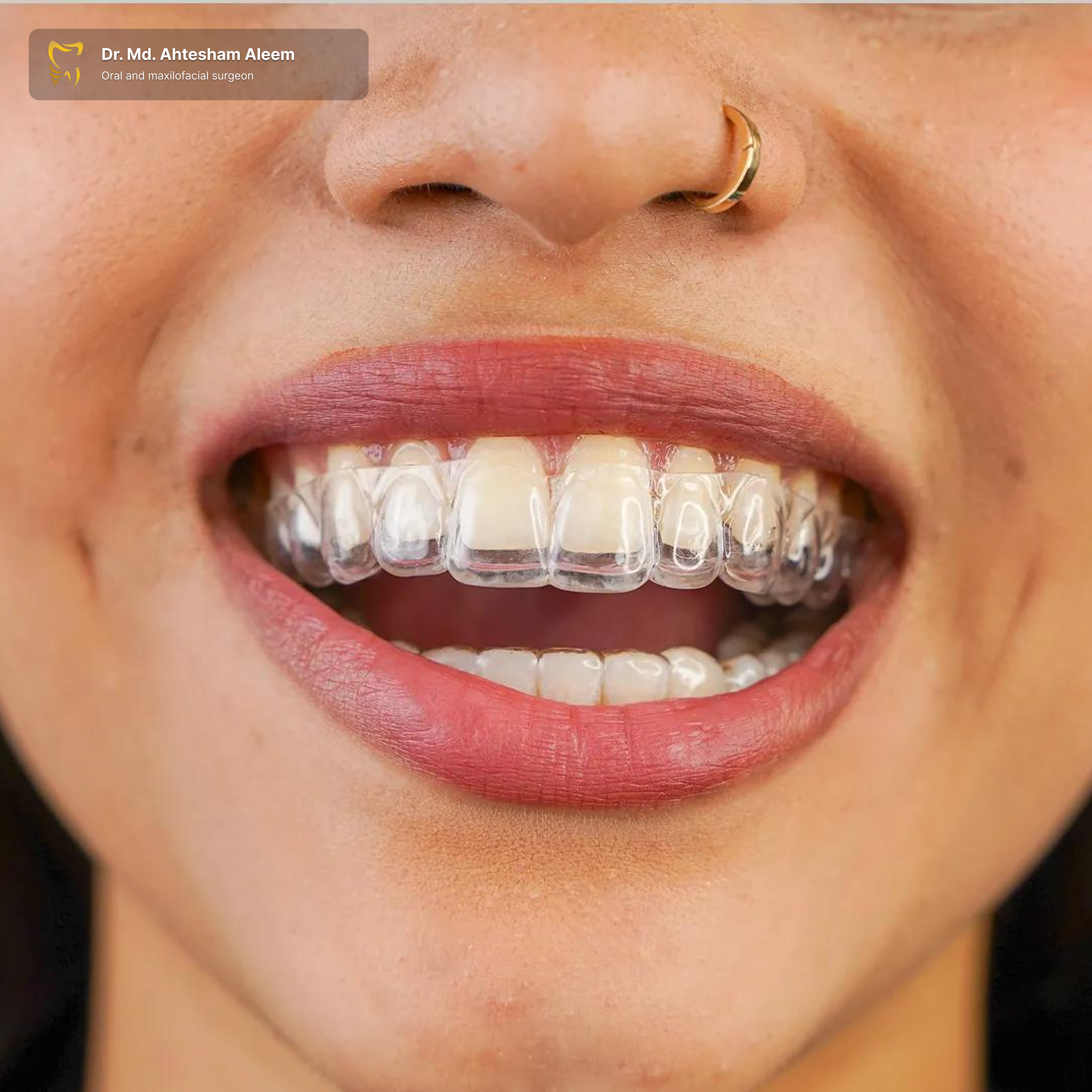 Invisalign®️ / Clear Aligners Gallery 1